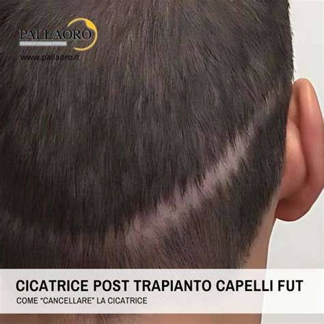 Eliminare La Cicatrice Da Trapianto Capelli Con La Micro Fue