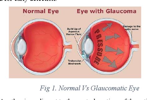 Figure 1 From A Deep Learning Approach To Computer Aided Glaucoma