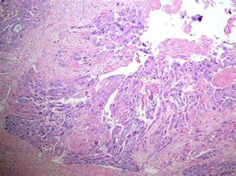 Uterine choriocarcinoma (postpartal) – BosnianPathology