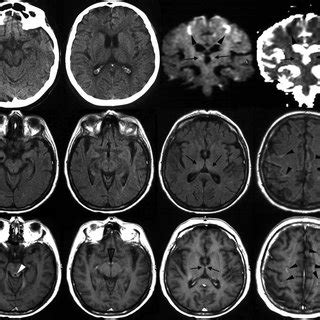 (PDF) CT and MRI of Wernicke's encephalopathy