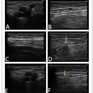 a SFJ before surgery: open deep vein. b GSV before surgery (diameter ...