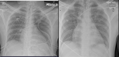 Chest X Ray Post Operation Showing Normal Cardiothoracic Ratio And Download Scientific Diagram