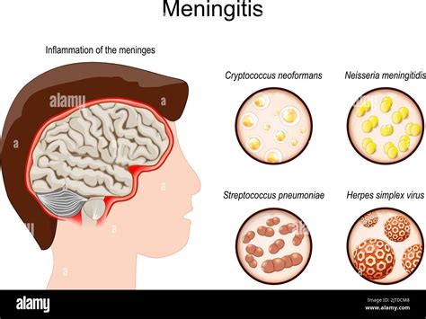 Diagrama De Células De Meningitis Bacteriana