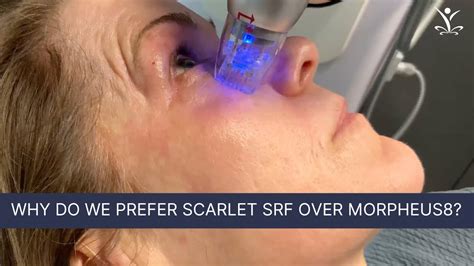 Powerful Skin Tightening With Radio Frequency Microneedling Youtube