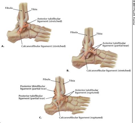 Ankle Sprain Grades