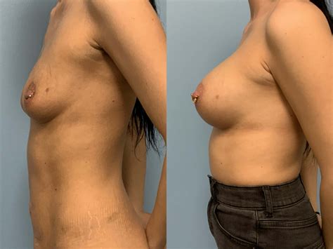 Breast Augmentation Gallery Dr Paul Vanek