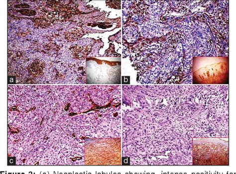 Figure 1 From A Rare Case Of Clear Cell Variant Of Oral Squamous Cell