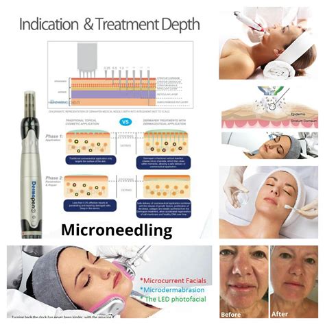 Collagen Induction Therapy For The Improvement Of Acne Scarring