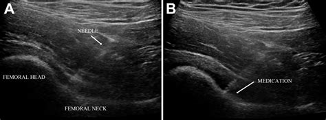 Ultrasound Therapy After Hip Replacement At Brittany Wertz Blog