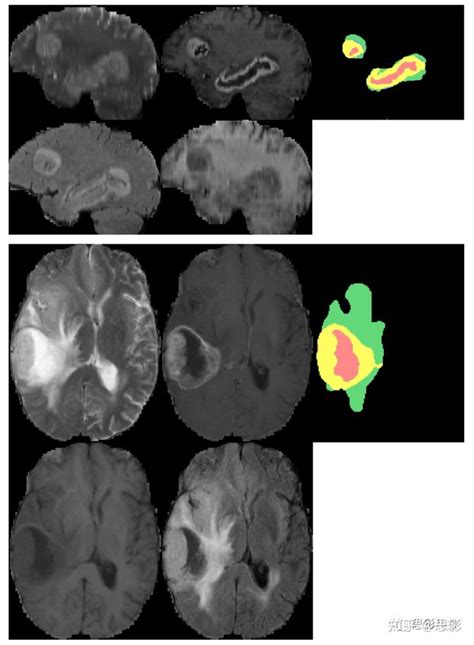 基于神经网络的脑肿瘤分割 知乎