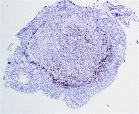 Pathology Outlines Follicular Lymphoma Duodenal Type