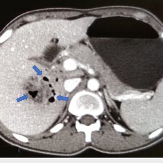 Contrast Enhanced Computed Tomography Of The Abdomen Showing Liver