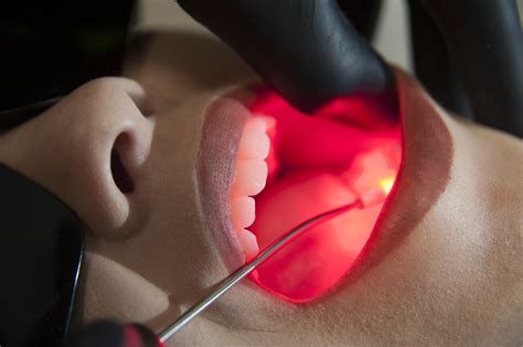 Laser Em Odontologia Quais Os Benef Cios E Os Melhores Aparelhos