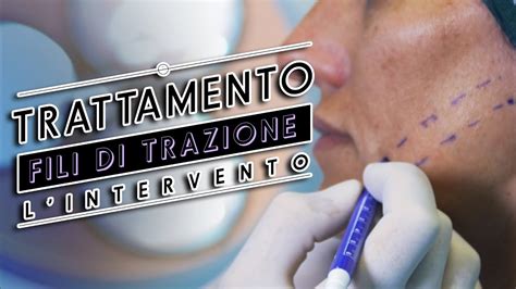 Fili Di Trazione Intradermici YouTube