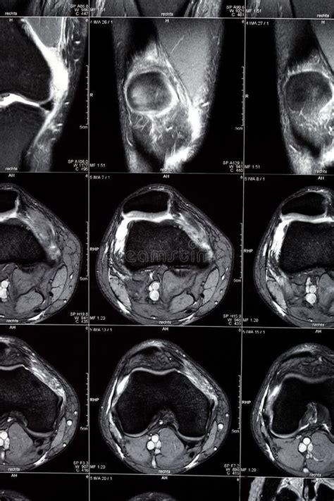 mrt scan stock photo image  hinge center joint picture