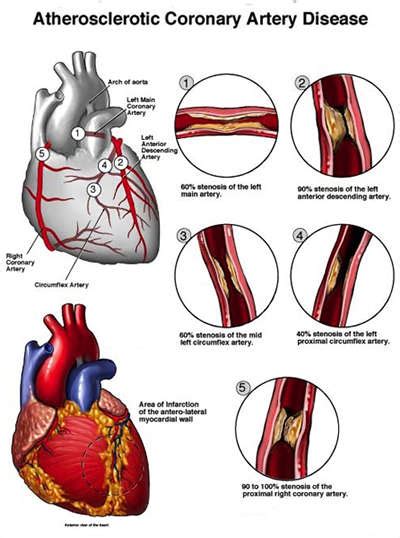 What Causes Angina Yms Your Medical Source