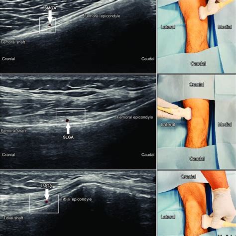 Probe Placement For Superior Medial Genicular Nerve Superior Lateral