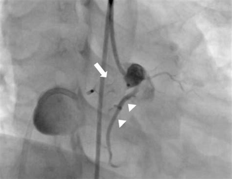 Right coronary artery (RCA) angiogram showed complete occlusion of ...