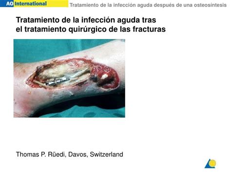 PPT Tratamiento de la infecci ón aguda tras el tratamiento quir