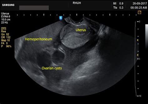 Ovarian Cyst Transabdominal Ultrasound