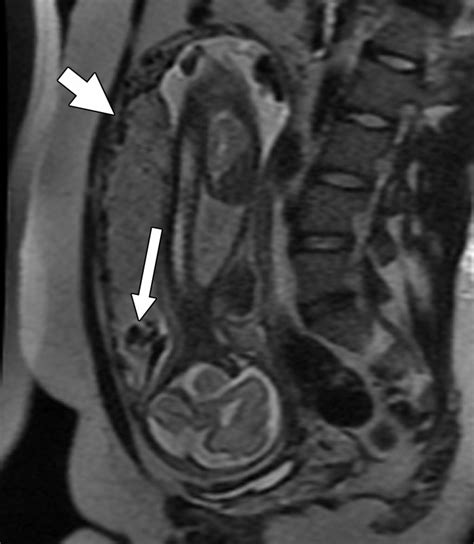 Placenta Accreta Mri