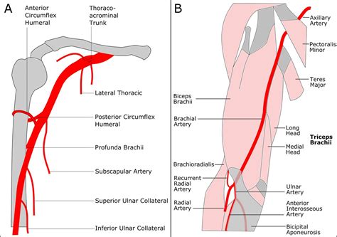 Radial Artery Access Anatomy Considerations For Neuroendovascular Procedures Journal Of