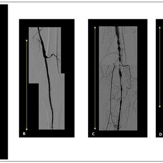 Selective Digital Subtraction Angiography A Left Distal Superficial