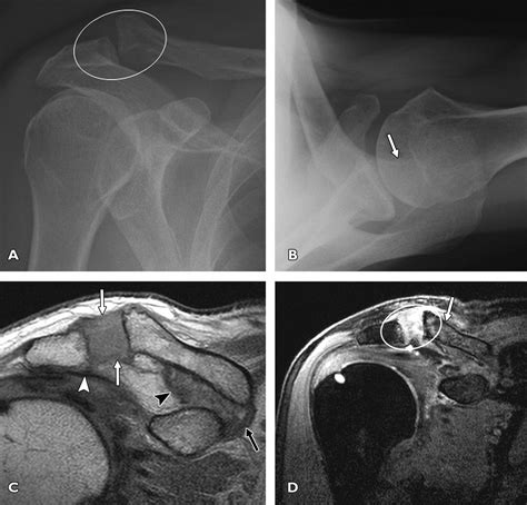 Inferior Acromioclavicular Ligament