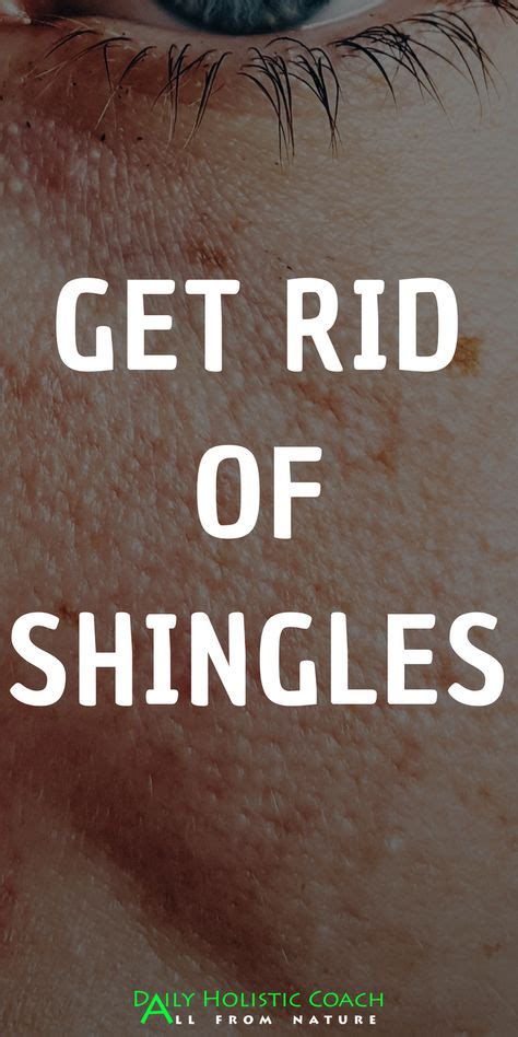 Get Rid Of Shingles Shingles Symptoms And Shingles Remedies