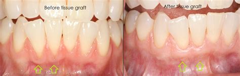 Gingival Graft Before And After