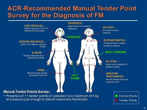 Fibro Tender Points Diagram - Wiring Diagram Pictures