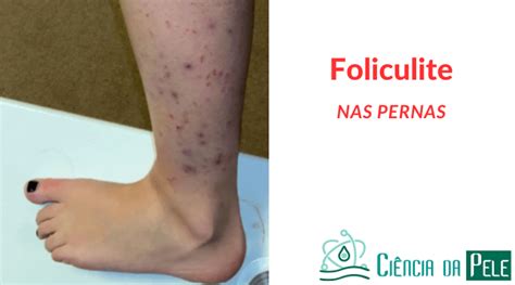 Foliculite Nas Pernas Causas Sintomas E Tratamentos Ci Ncia Da Pele