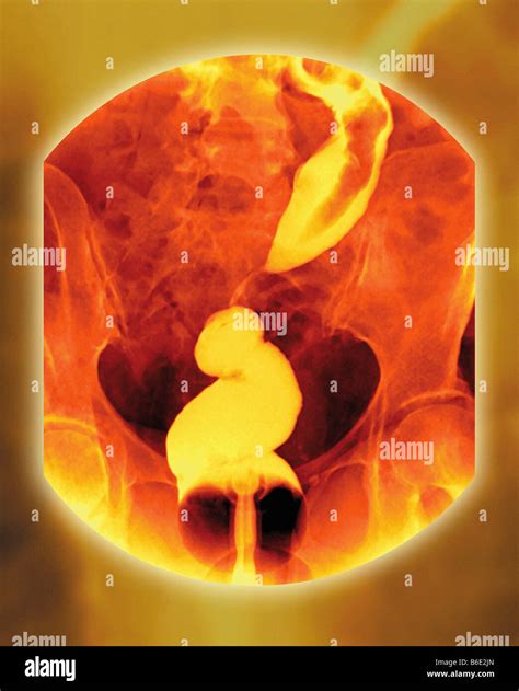 Colorectal Cancer Xray Hi Res Stock Photography And Images Alamy