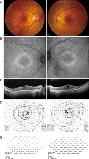 Diagnosis And Treatment Of Autoimmune Retinopathy Lin Annals Of Eye