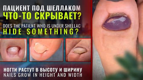 Пациент под шеллаком, что-то скрывает? Ногти растут в высоту и ширину # ...