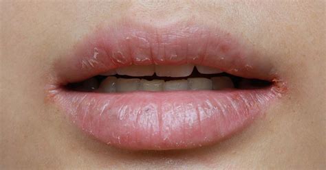 Trockene Lippen Ursachen Und Pflege Dr Leenarts