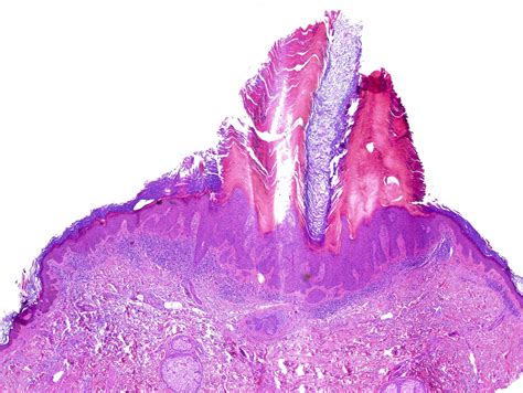 Actinic Keratosis Histology