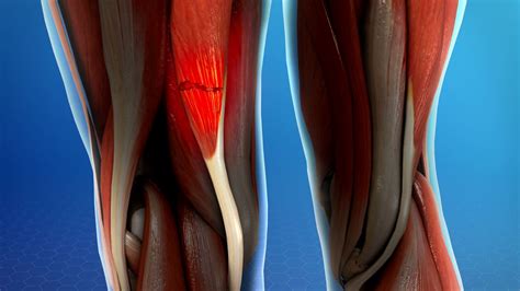 Bursite De Biceps Femoral LIBRAIN