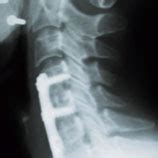 Straightforward Spinal Surgery Georgia Spine Neurosurgery Center