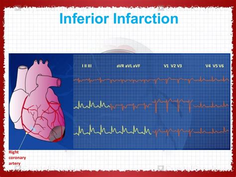 Ecg In Ischemic Heart Disease Dr Vivek Baliga Review