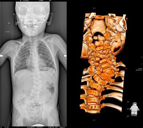 Escoliosis congénita Cirugia de columna