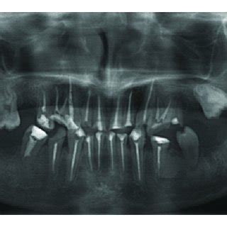 Intraoral A And Radiographic B View Of The Patient After Initial