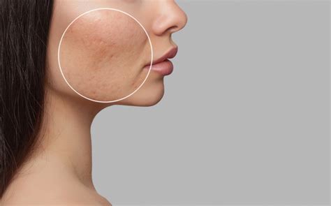 Plastic Surgery And Acne Scars Is There A Solution Dr Thomas Loeb