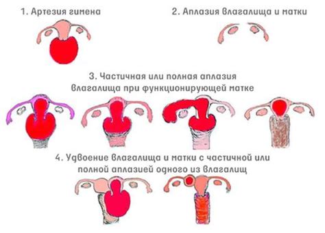 Генитальный инфантилизм: виды, причины, лечение