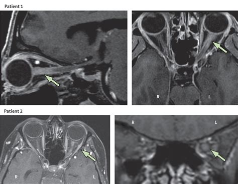 Optic Neuritis The Lancet Neurology