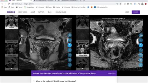 Mri Pro Prostate Mri Training Course Tutorial Youtube