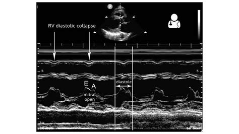 Echocardiography In Cardiac Tamponade Ppt