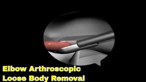 Elbow Arthroscopy Loose Body Removal 관절경하 팔꿈치 유리체 제거술 YouTube