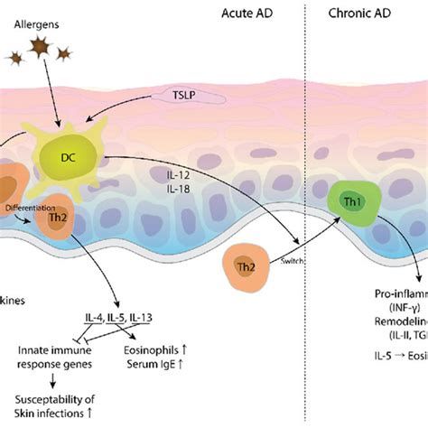 Acute And Chronic Phases Of Atopic Dermatitis AD 1 In Acute AD