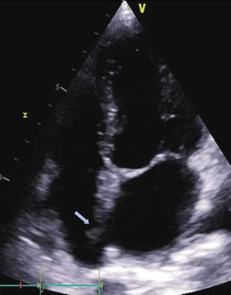 Follow Up Transthoracic Echocardiogram Showing Resolution Of The Right